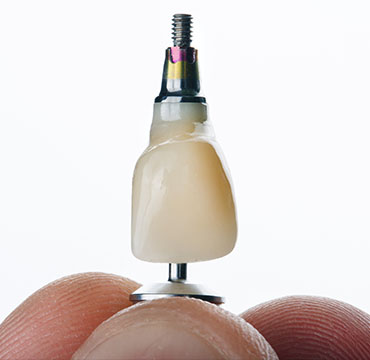 Korona/most na implantach